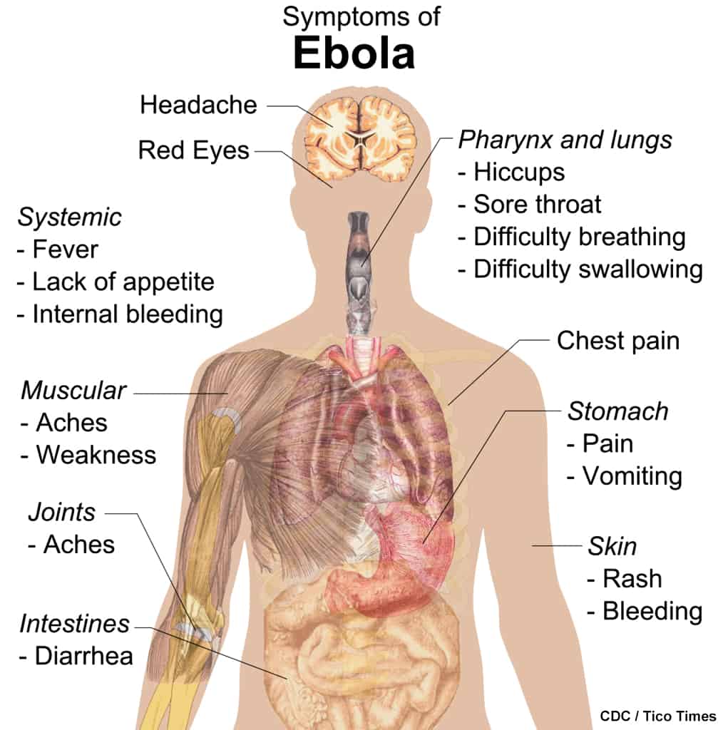Ebola Virus symptoms