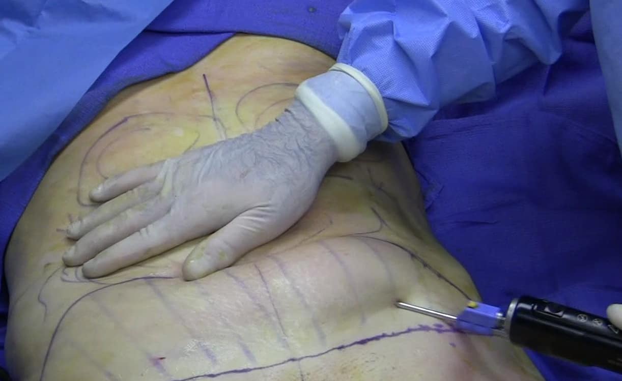 A woman undergoing liposuction.