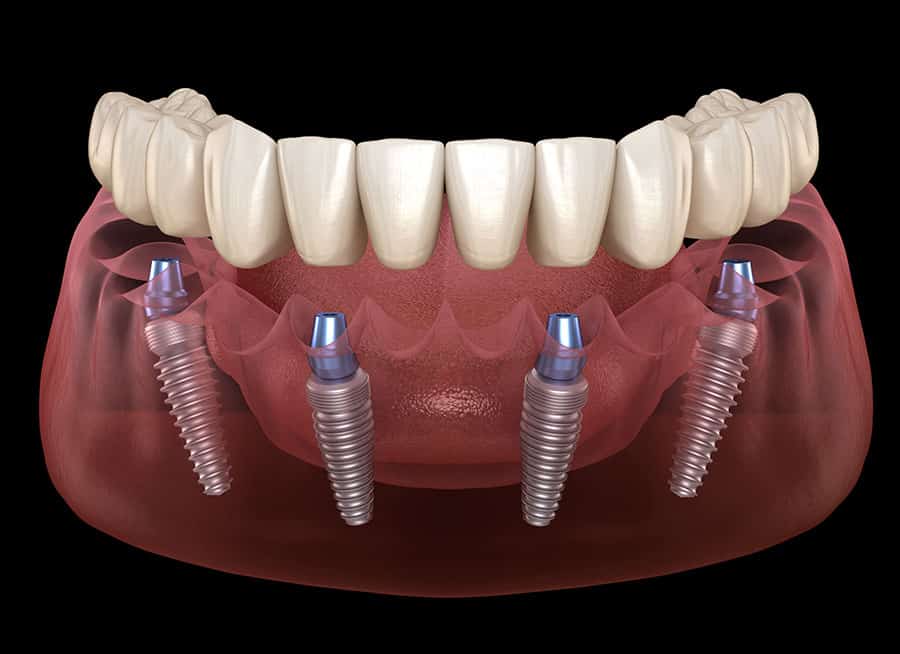 Image result for dental implants