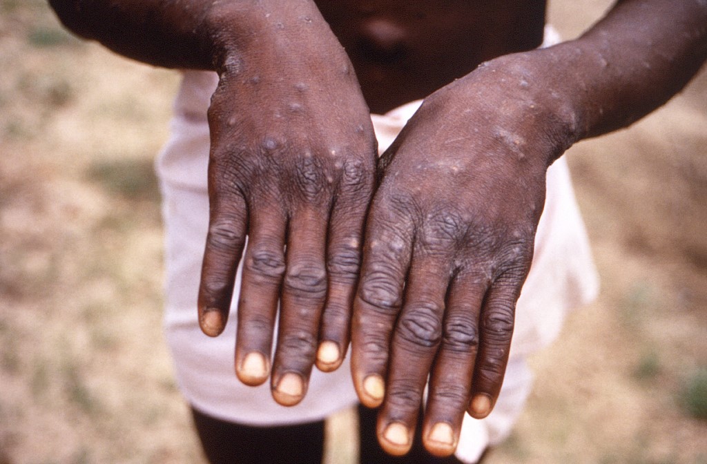 WHO Declares End to Global Health Emergency: MPOX